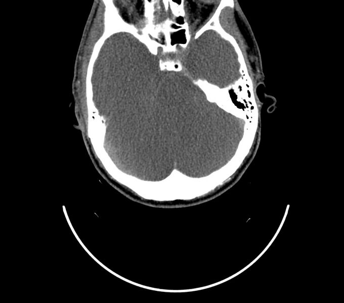 File:Cerebral edema in an overdose patient (Radiopaedia 72005-82539 A 260).jpg