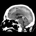 Cerebral hemorrhagic contusions (Radiopaedia 23145-23188 C 22).jpg