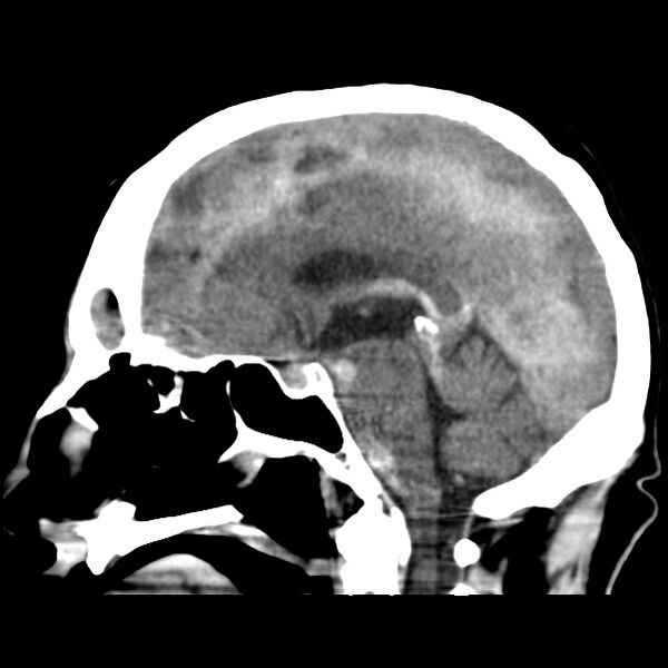 File:Cerebral hemorrhagic contusions (Radiopaedia 23145-23188 C 22).jpg