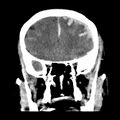 Cerebral hemorrhagic contusions (Radiopaedia 23145-23188 Coronal non-contrast 14).jpg