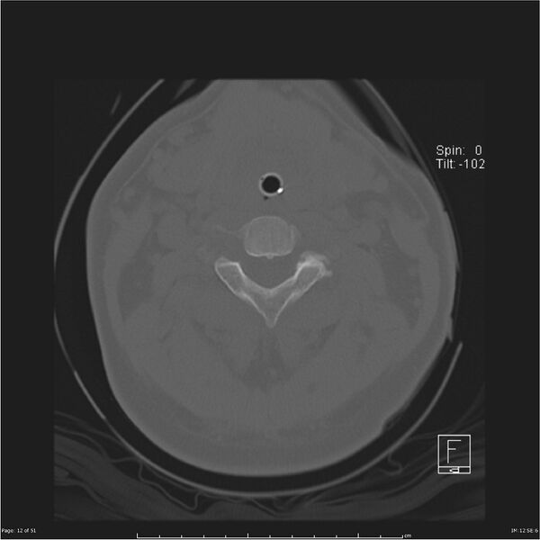 File:Cerebral hemorrhagic contusions and cervical spine fractures (Radiopaedia 32865-33841 C 12).jpg