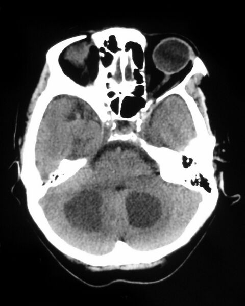 File:Cerebral metastases - small cell lung cancer (Radiopaedia 3972-6522 Axial non-contrast 1).jpg