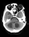 Cerebral metastases - small cell lung cancer (Radiopaedia 3972-6522 Axial non-contrast 1).jpg
