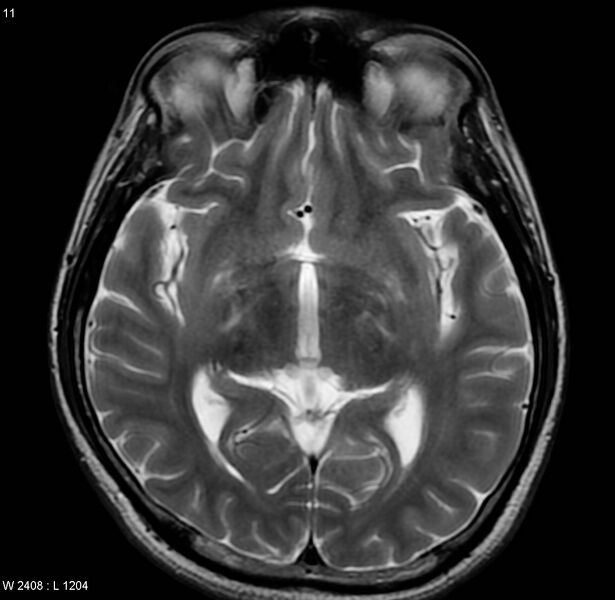 File:Cerebral vasculitis (Radiopaedia 5131-6923 Axial T2 2).jpg