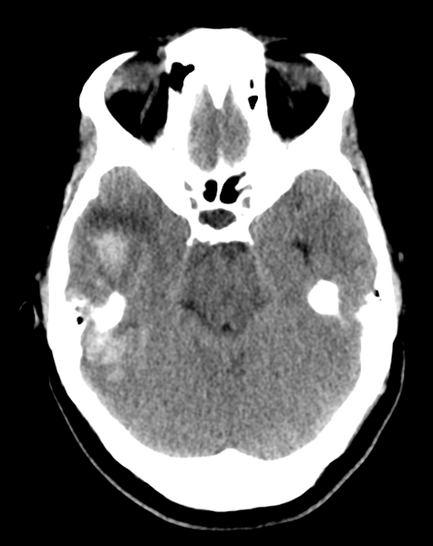File:Cerebral venous infarct related to dural venous sinus thromboses (Radiopaedia 35292-36803 AXIAL THICK 9).png