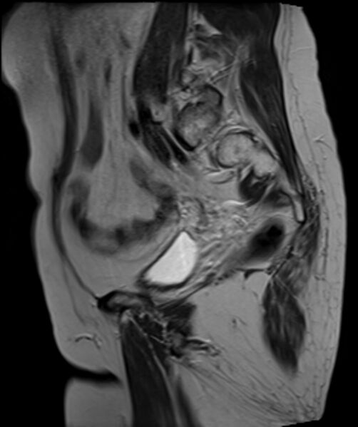 File:Cervical carcinoma (Radiopaedia 88312-104943 Sagittal T2 11).jpg