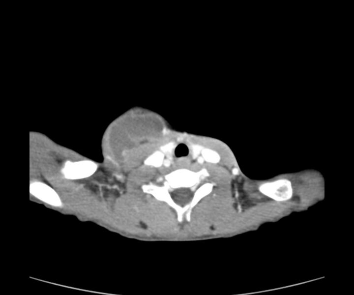 File:Cervical cystic lymphangioma (Radiopaedia 63655-72332 Axial + contrast 21).jpg