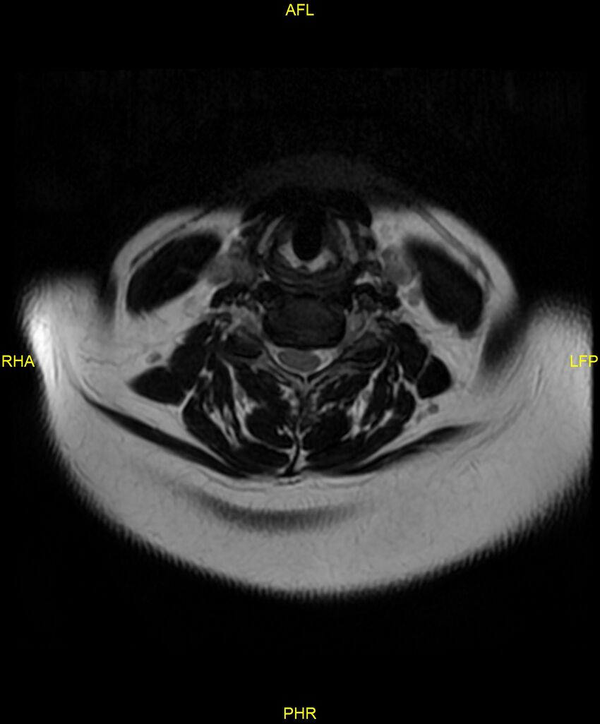 Cervical disc protrusion (Radiopaedia 87147-103415 Axial T2 22).jpg