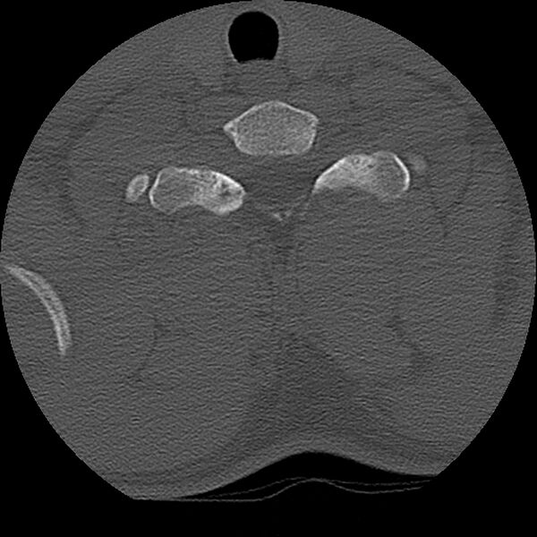 File:Cervical flexion teardrop fracture with cord hemorrhage (Radiopaedia 32497-33454 Axial bone window 70).jpg
