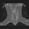 Cervical spondylolysis (Radiopaedia 49616-54811 Sagittal bone window 1).png
