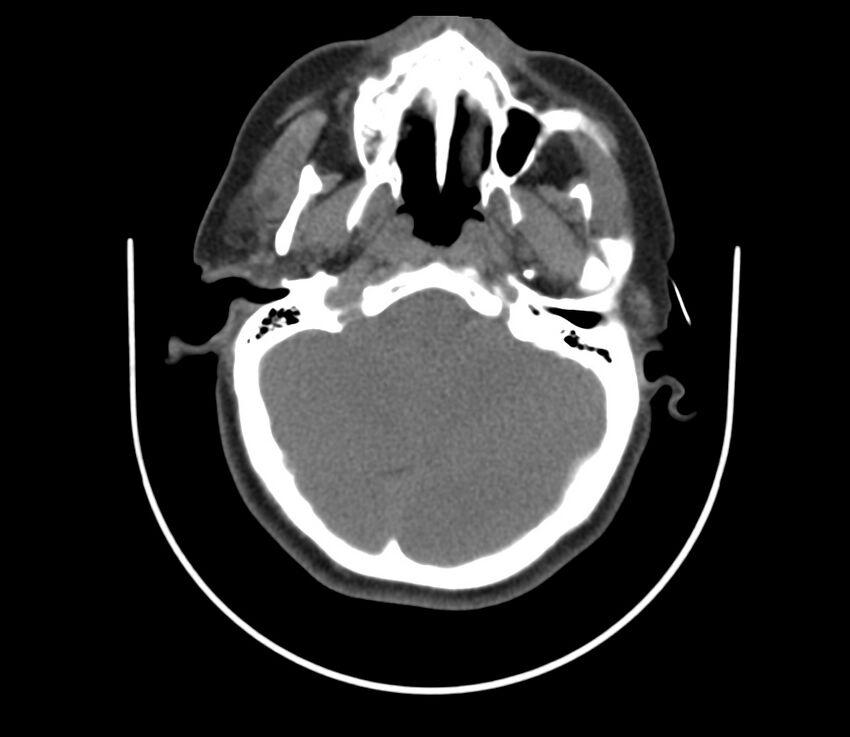 Cervical venous malformation (Radiopaedia 22653-22672 Axial non-contrast 14).jpg