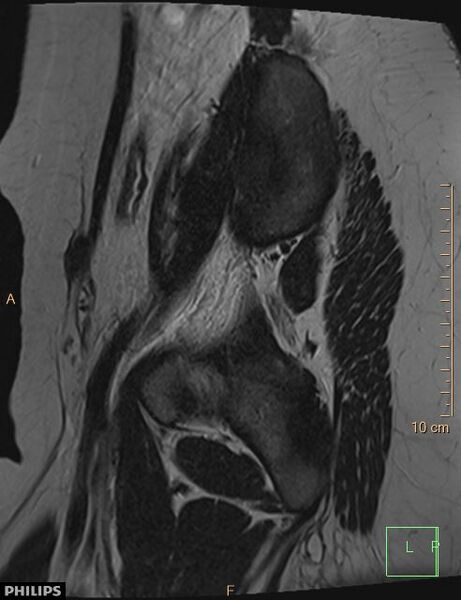 File:Cesarian scar endometriosis (Radiopaedia 68495-78066 Sagittal T2 27).jpg