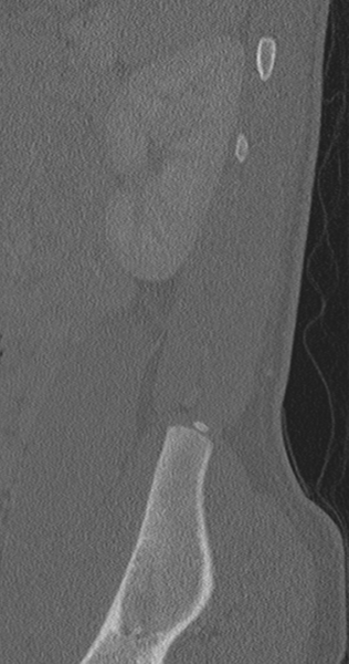 File:Chance fracture (Radiopaedia 40360-42912 Sagittal bone window 11).png