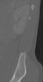 Chance fracture (Radiopaedia 40360-42912 Sagittal bone window 11).png