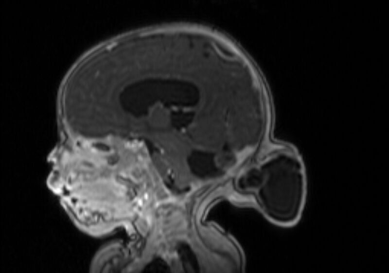 File:Chiari III malformation with occipital encephalocele (Radiopaedia 79446-92559 Sagittal T1 C+ mpr 39).jpg