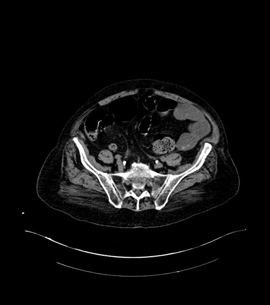 File:Cholangiocarcinoma with cerebral metastases (Radiopaedia 83519-98629 Axial non-contrast 94).jpg