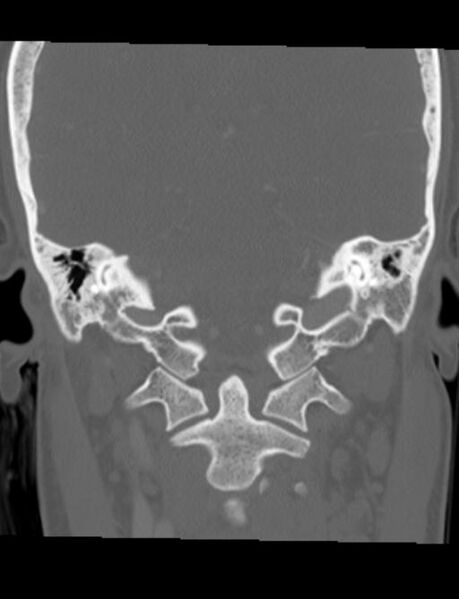 File:Cholesteatoma (pars flaccida) (Radiopaedia 28782-29083 Coronal bone window 8).jpg