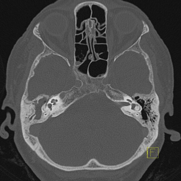 File:Cholesteatomatous chronic otitis (Radiopaedia 14993-14911 Axial bone window 10).JPEG