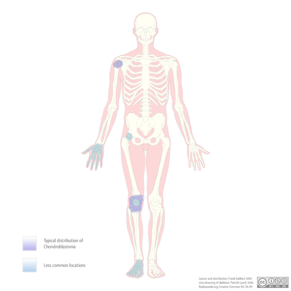 File:Chondroblastoma - distribution (diagram) (Radiopaedia 9270).png