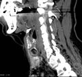 Chondrosarcoma - larynx (Radiopaedia 4588-6698 C 2).jpg