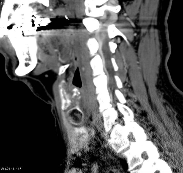 File:Chondrosarcoma - larynx (Radiopaedia 4588-6698 C 2).jpg