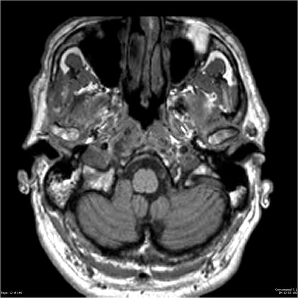 File:Chondrosarcoma of skull base- grade II (Radiopaedia 40948-43654 Axial T1 12).jpg
