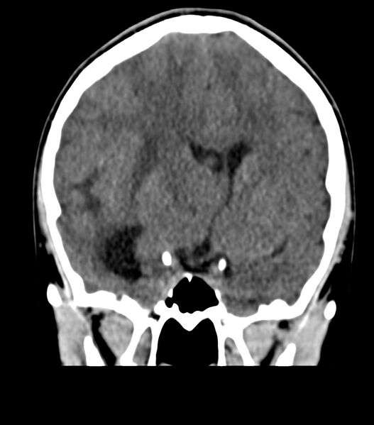 File:Choroid plexus carcinoma (Radiopaedia 91013-108552 Coronal non-contrast 36).jpg