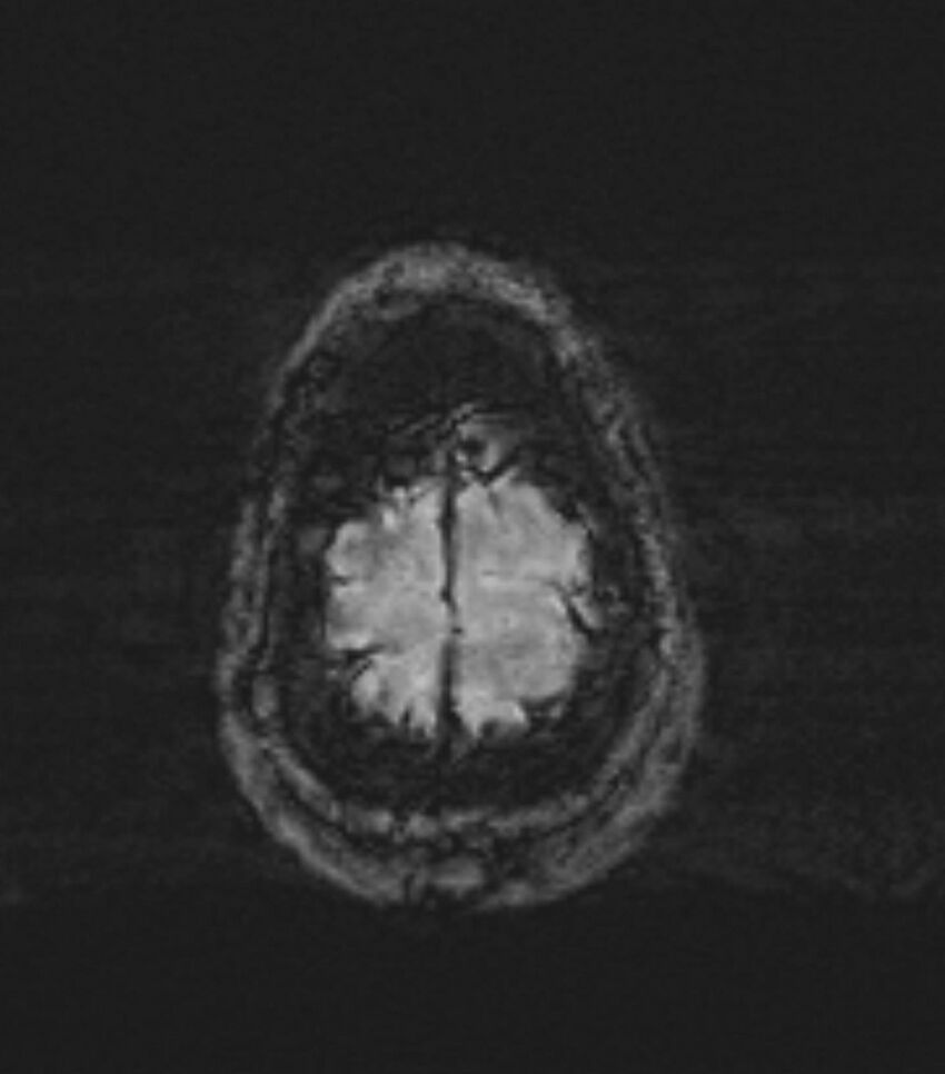 Choroid plexus carcinoma (Radiopaedia 91013-108553 Axial SWI 90).jpg