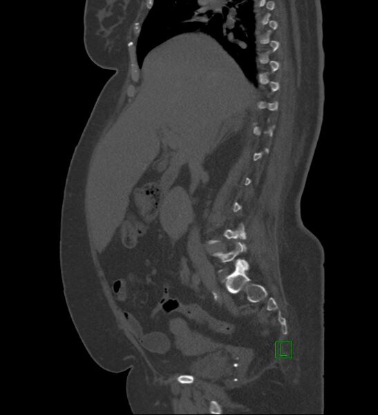 File:Chromophobe renal cell carcinoma (Radiopaedia 84239-99519 Sagittal bone window 66).jpg