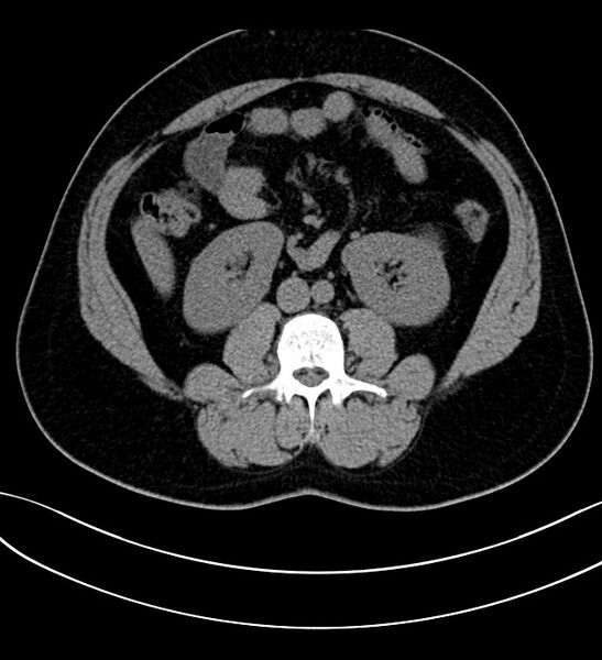 File:Chromophobe renal cell carcinoma (Radiopaedia 84286-99573 Axial non-contrast 28).jpg