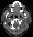 Chronic Submandibular sialolithiasis (Radiopaedia 16880-16606 Axial non-contrast 4).jpg