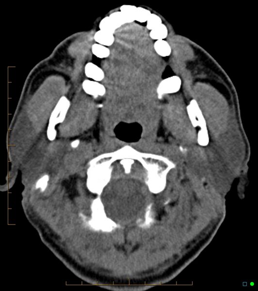 File:Chronic Submandibular sialolithiasis (Radiopaedia 16880-16606 Axial non-contrast 4).jpg