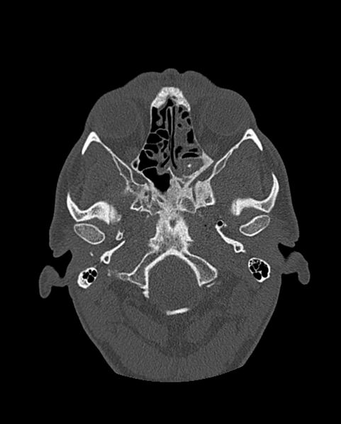 File:Chronic maxillary sinusitis caused by a foreign body (Radiopaedia 58521-65676 Axial bone window 191).jpg