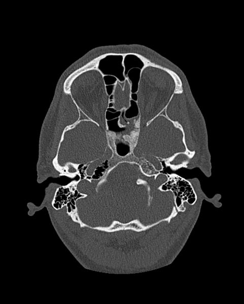 File:Chronic maxillary sinusitis caused by a foreign body (Radiopaedia 58521-65676 Axial bone window 227).jpg