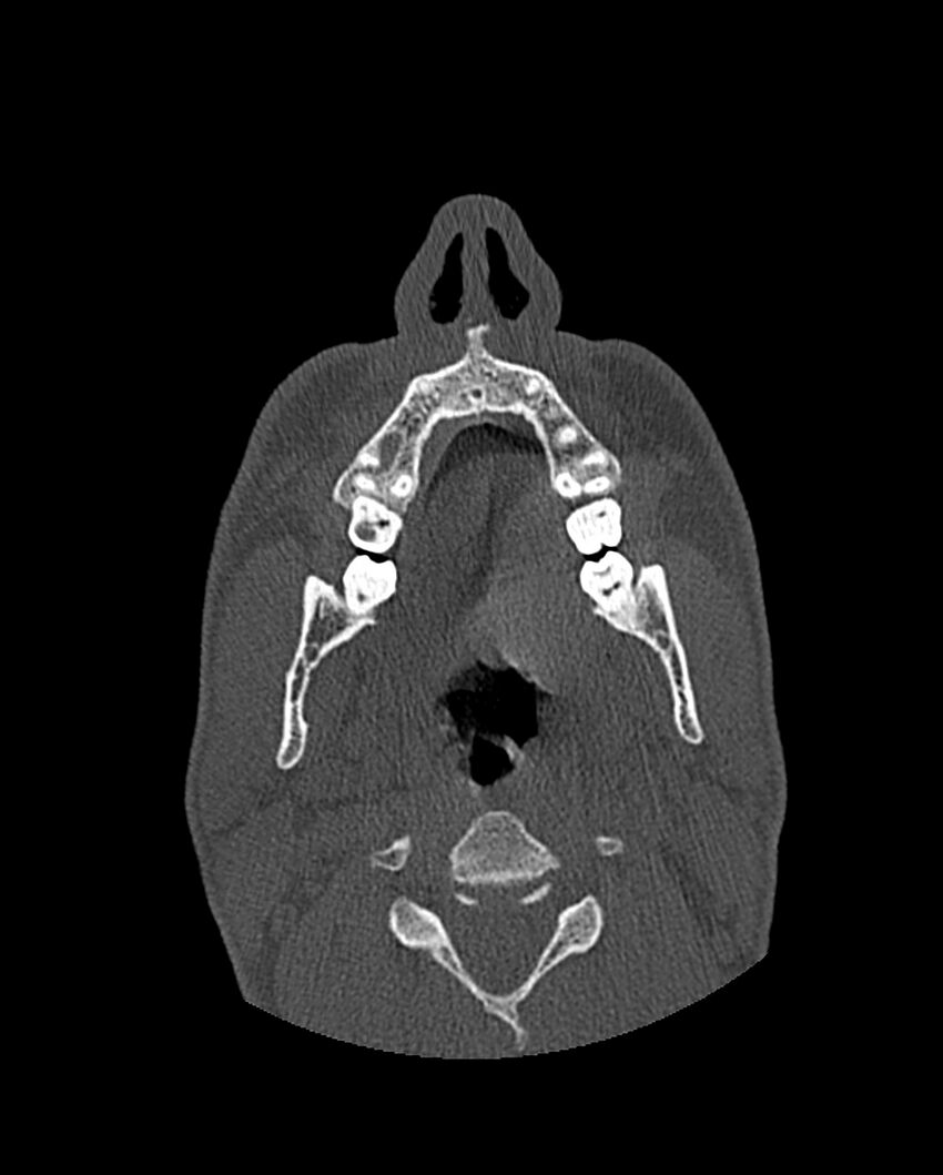 Chronic maxillary sinusitis caused by a foreign body (Radiopaedia 58521-65676 Axial bone window 27).jpg