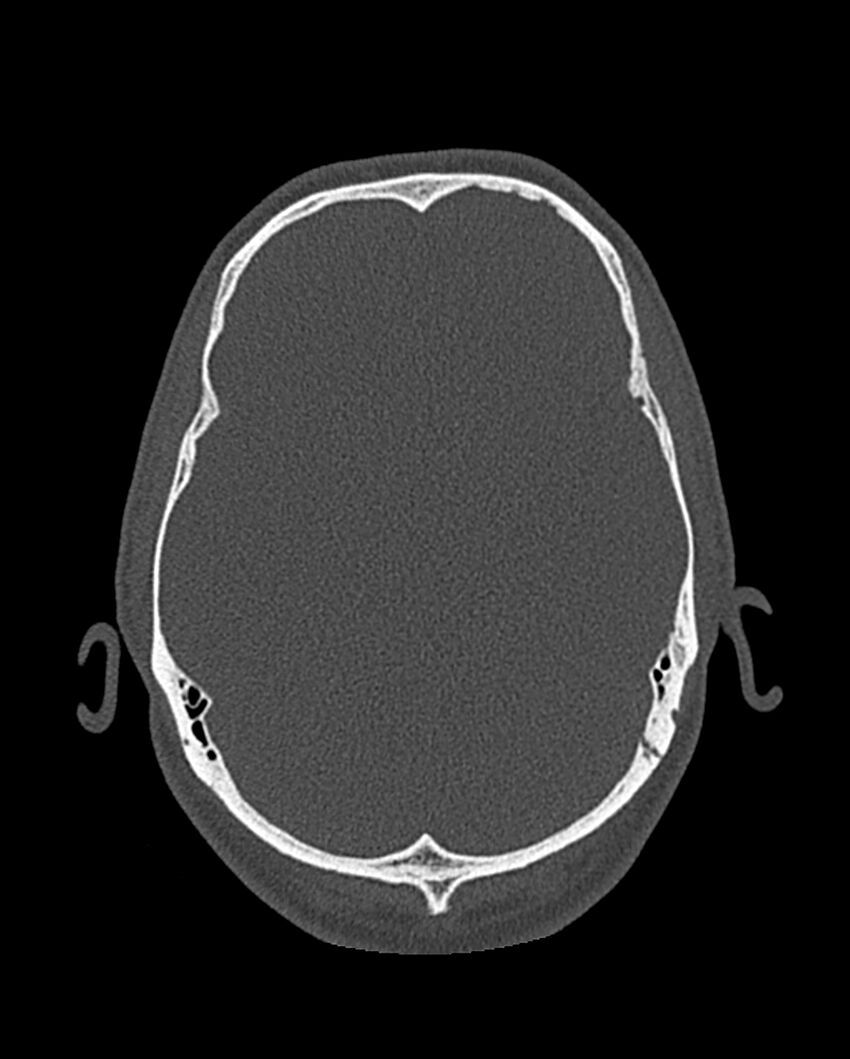 Chronic maxillary sinusitis caused by a foreign body (Radiopaedia 58521-65676 Axial bone window 316).jpg