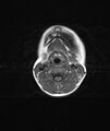Chronic reactive multifocal osteomyelitis (CRMO) - mandible (Radiopaedia 56405-63069 Axial T1 5).jpg
