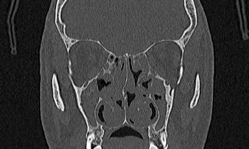 File:Chronic rhinosinusitis (Radiopaedia 65079-74075 Coronal bone window 41).jpg