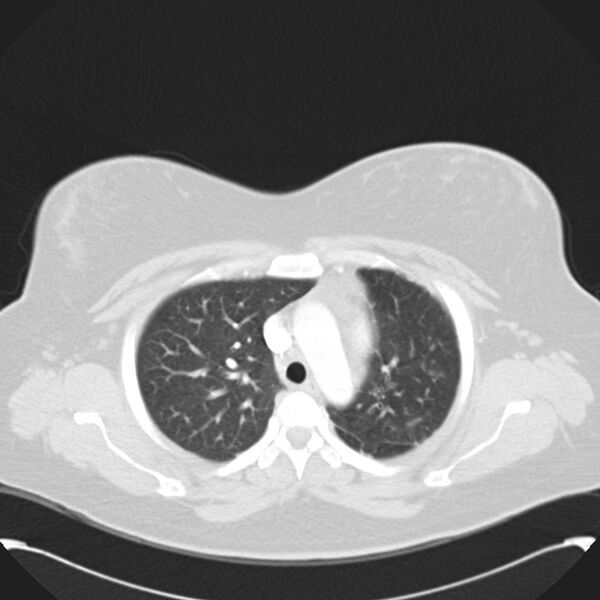 File:Chronic thromboembolic pulmonary hypertension (CTEPH) (Radiopaedia 74597-85531 Axial lung window 16).jpg