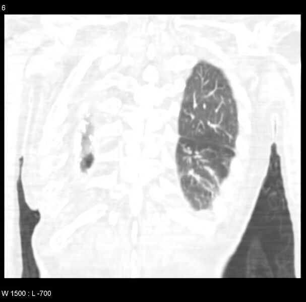 File:Clagett thoracotomy (Radiopaedia 8568-9403 Coronal lung window 6).jpg