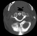 Clay-shoveler fracture (Radiopaedia 22568-22590 Axial bone window 11).jpg