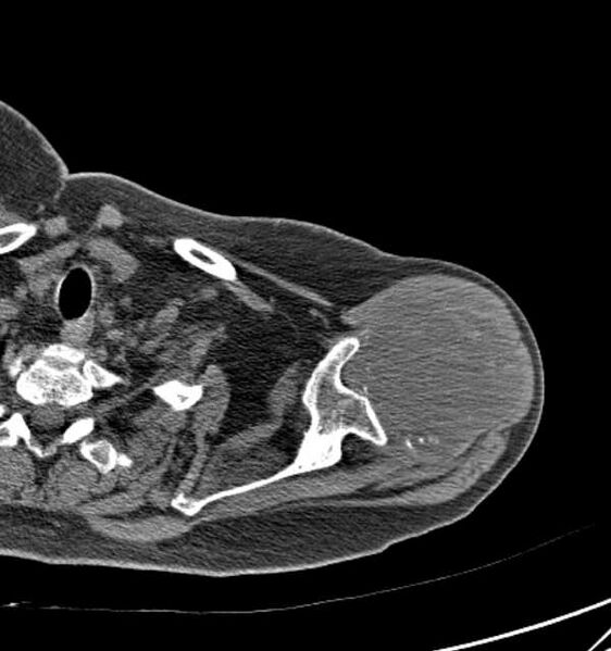 File:Clear cell chondrosarcoma - humerus (Radiopaedia 63104-71612 Axial non-contrast 27).jpg