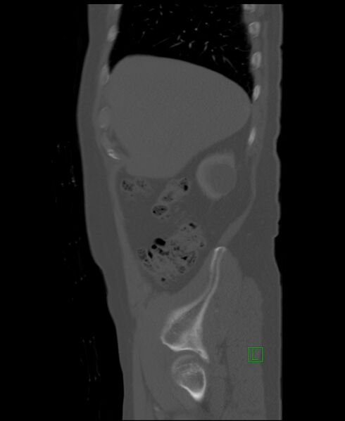 File:Clear cell renal cell carcinoma (Radiopaedia 85006-100539 Sagittal bone window 50).jpg