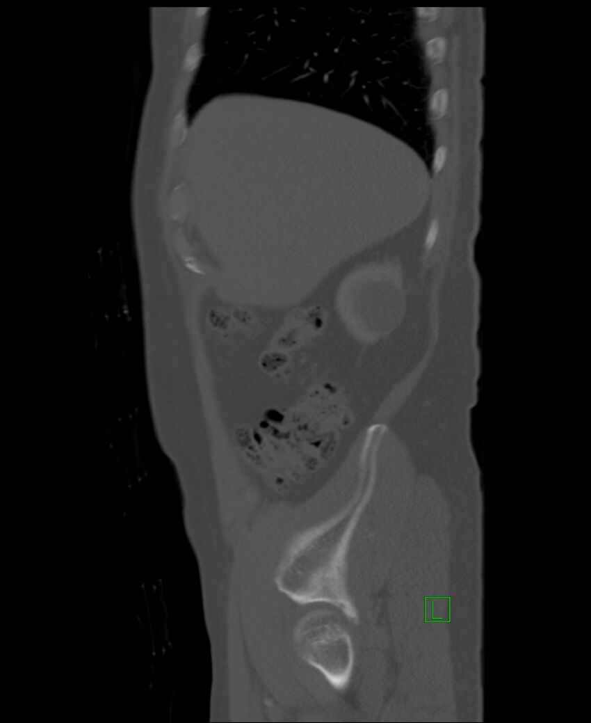 Clear cell renal cell carcinoma (Radiopaedia 85006-100539 Sagittal bone window 50).jpg