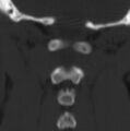 Cleft of the posterior arch of C1 mimicking fracture (Radiopaedia 40201-42721 Coronal bone window 4).jpg
