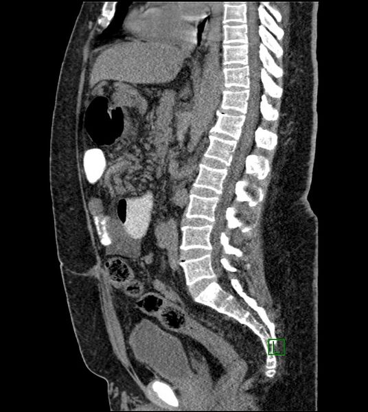 File:Closed-loop small bowel obstruction-internal hernia (Radiopaedia 78439-91096 C 76).jpg