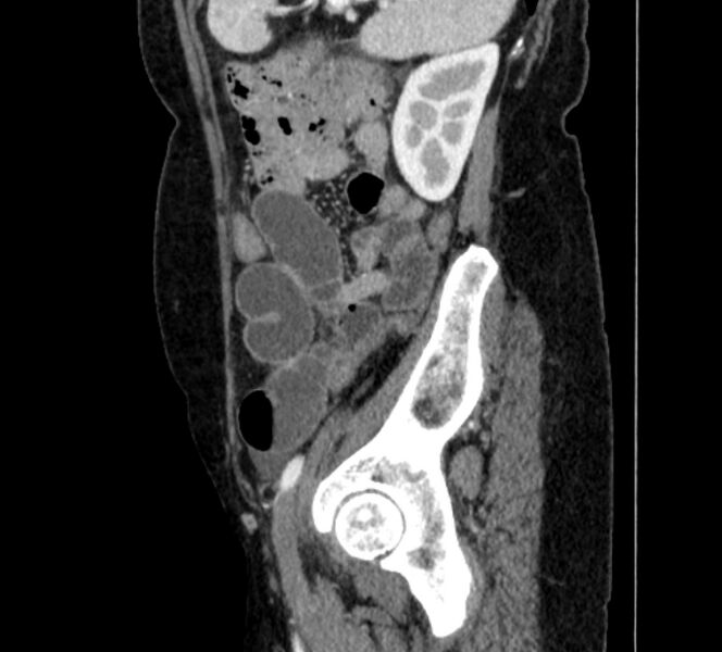 File:Closed loop small bowel obstruction (Radiopaedia 71211-81508 C 129).jpg