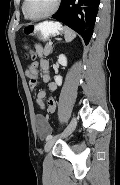 File:Closed loop small bowel obstruction - internal hernia (Radiopaedia 57806-64778 C 40).jpg