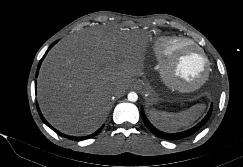 File:Coarctation of aorta with aortic valve stenosis (Radiopaedia 70463-80574 A 208).jpg