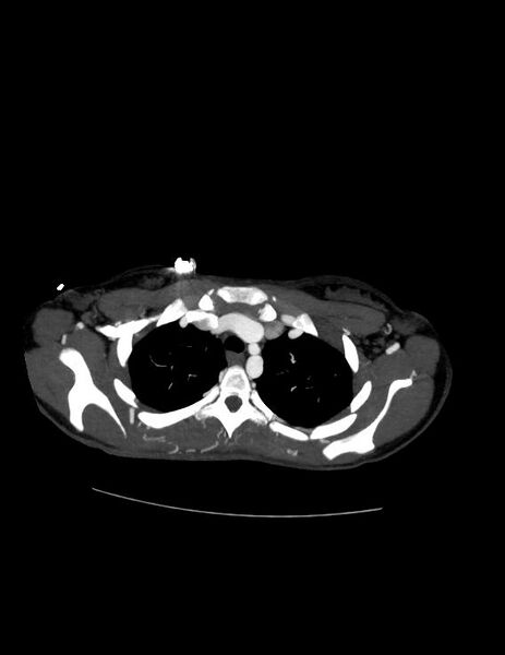 File:Coarctation of the aorta (Radiopaedia 27458-27657 D 6).jpg